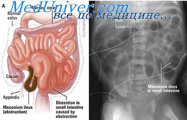 кишечная непроходимость