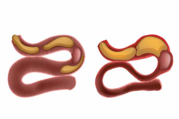 Кишечная непроходимость