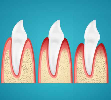 Лечение гингивита, пародонтита, пародонтоза в стоматологической клинике Литфонда