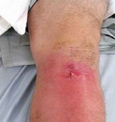 Фото Инфекционный артрит