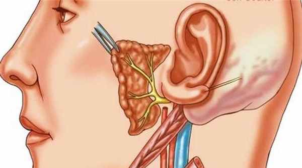 Неврит слухового нерва