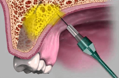 инфильтрационная анестезия в стоматологии