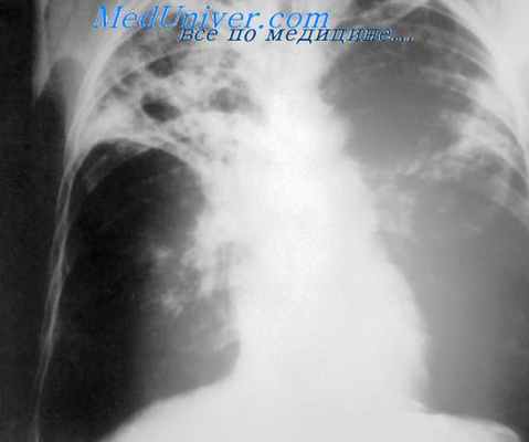 микобактерии туберкулеза