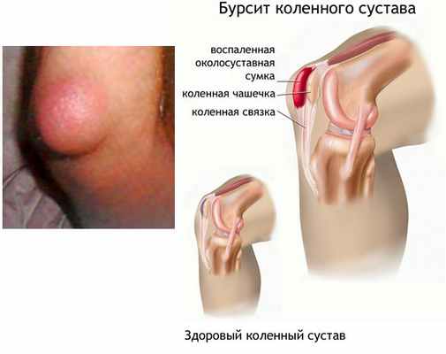 Бурсит коленного сустава фото