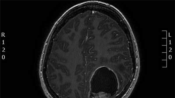 Эпендимомы