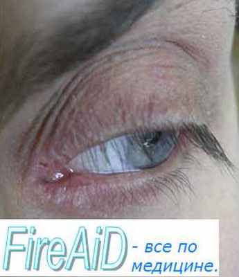 инфузионная терапия сепсиса