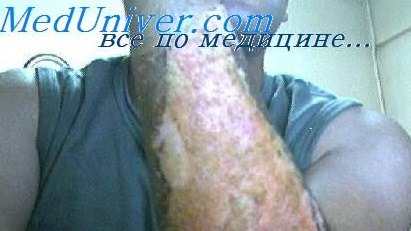 лечение ожогового шока