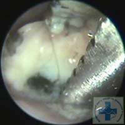 Удаление кости из просвета пищевода у грифона