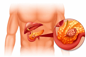 Инсулинома