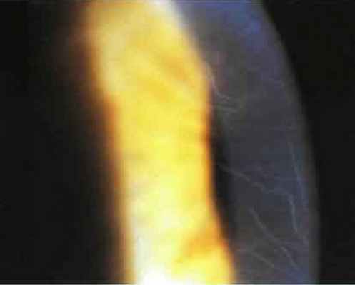 Тени сосудов роговицы