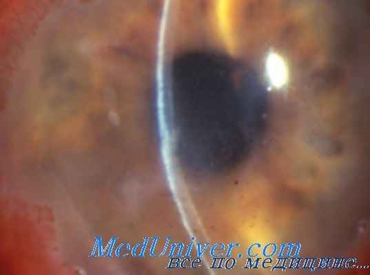 кератит у детей