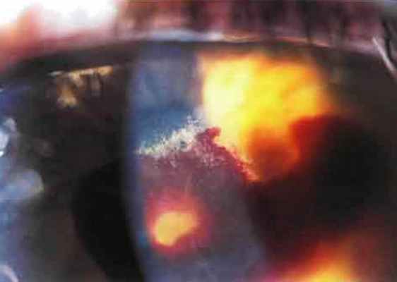 Интерстициальный кератит - стромальные гоморрагии