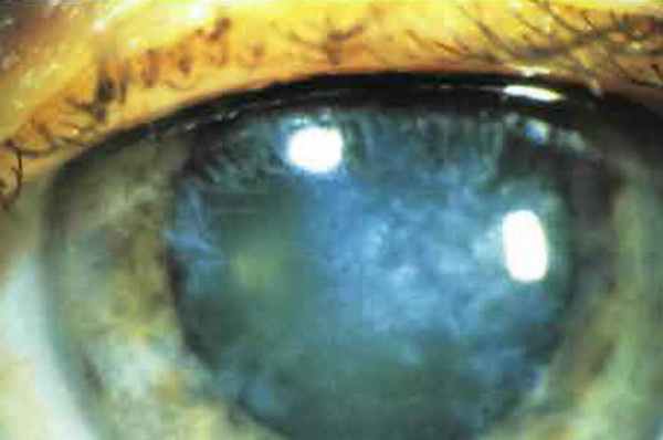 Рубцевание стромы при интерстициальном кератите