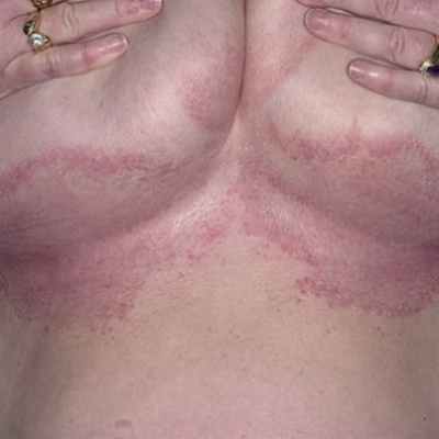 Причины и лечение интертригинозного дерматита