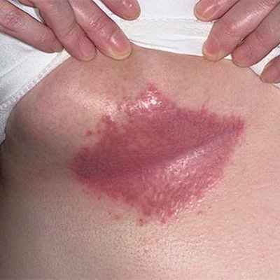 Причины и лечение интертригинозного дерматита