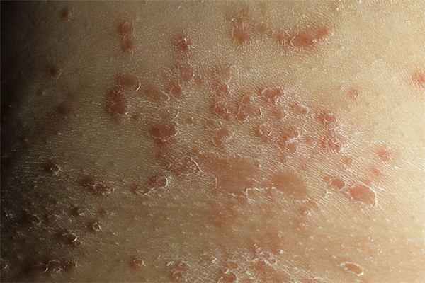 Интертригинозный дерматит