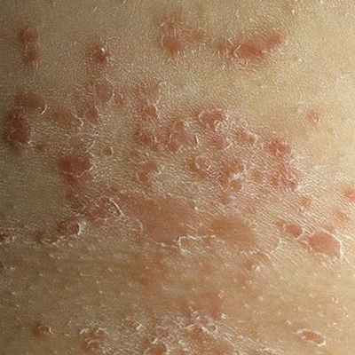 Причины и лечение интертригинозного дерматита