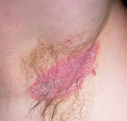 Опрелость (интертригинозный дерматит) в зоне подмышки