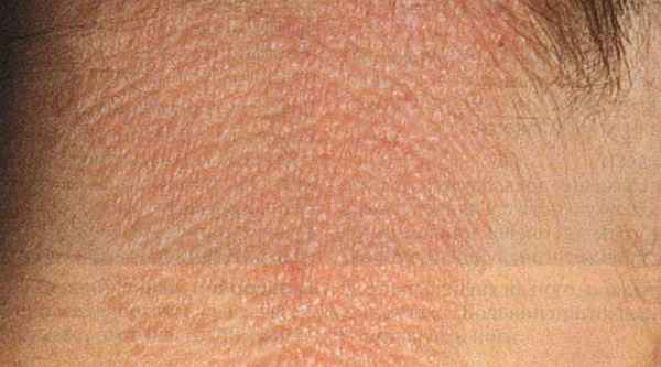 Фото Интертригинозный дерматит