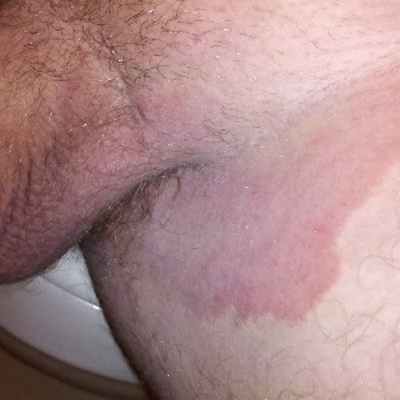 Причины и лечение интертригинозного дерматита