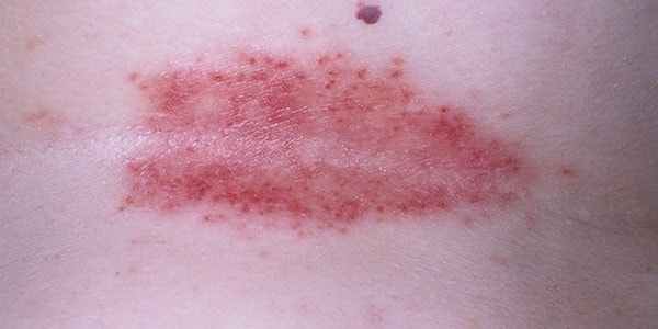 Причины и лечение интертригинозного дерматита