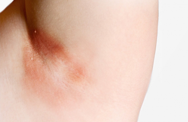 Интертриго