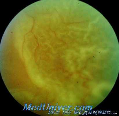 осложнения пневморетинопексии