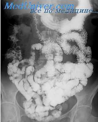 инсуфляция кишки