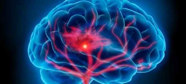 ишемический инсульт мозга