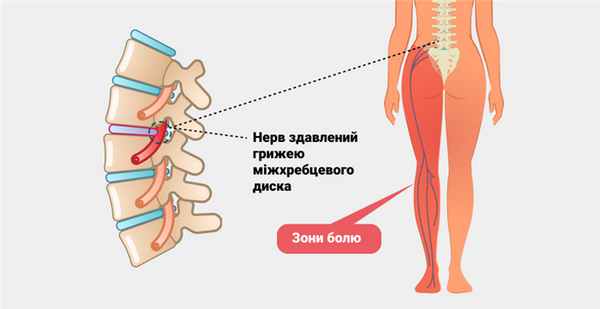 Ишиалгия седалищного нерва