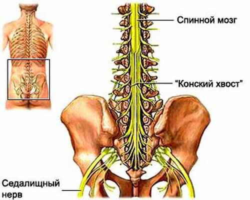 Лечение ишиаса
