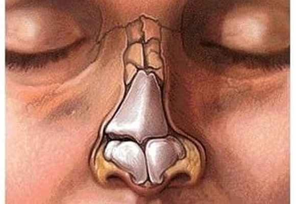 Перелом костей носа