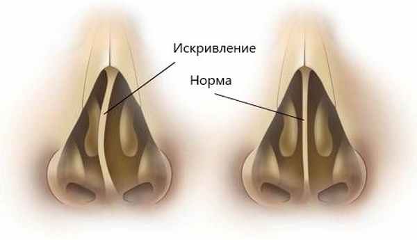 Искривление и норма