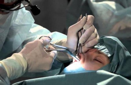 Септопластика классическим способом