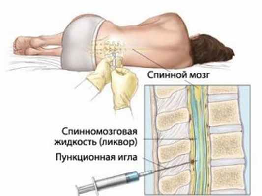 Биопсия костного мозга