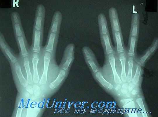 кости на рентгенограмме