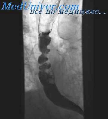 опухоли пищевода