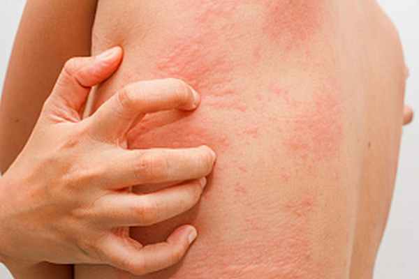 Холодовая аллергия: причины, симптомы, диагностика и лечение