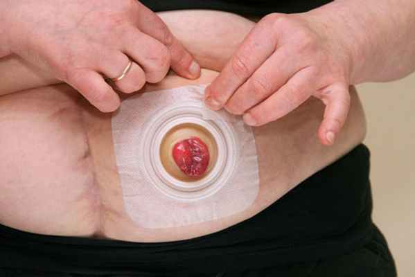 Правильное снятие калоприемника