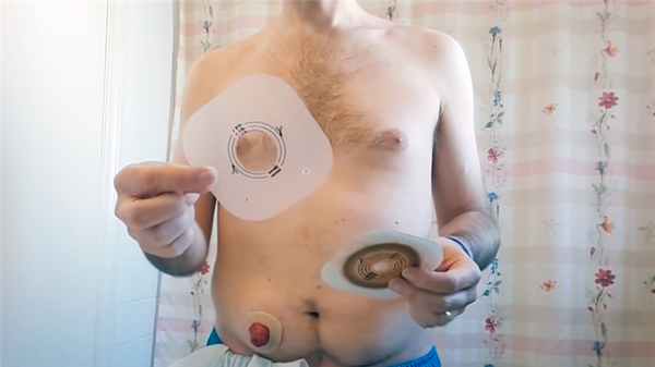 Трафарет для определение размера стомы