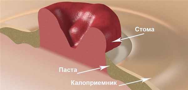 Паста для стомы