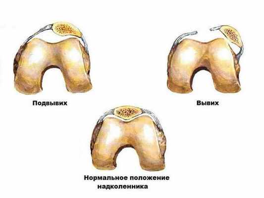 Травмы надколенника