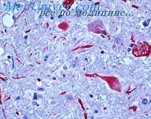 калифорнийский энцефалит