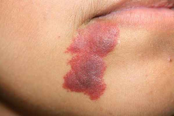 Утолщение и потемнение винного пятна