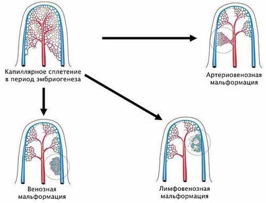 Виды сосудистых аномалий