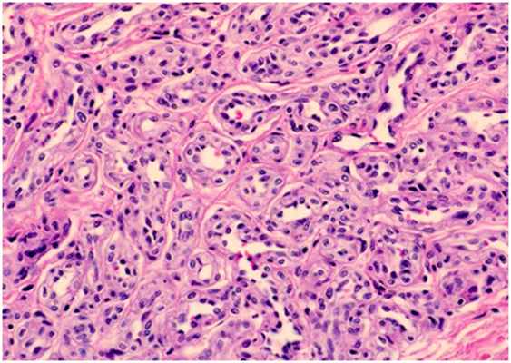 Глубоко залегающие сосуды - гистологическая картина гемангиомы