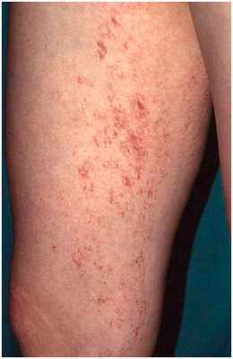 Глубоко залегающие сосуды - телеангиэктазии на бедре