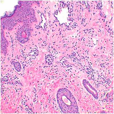 Глубоко залегающие сосуды - капиллярная мальформация