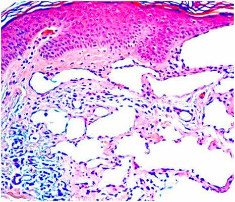 Глубоко залегающие сосуды - лимфатическая мальформация