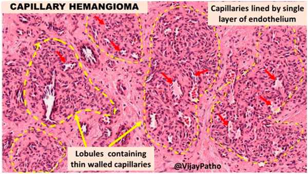 Глубоко залегающие сосуды - гистологическая картина капиллярной гемангиомы